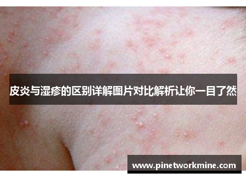皮炎与湿疹的区别详解图片对比解析让你一目了然 皮炎与湿疹的区别详解图片对比解析让你一目了然